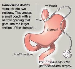 what is gastric banding