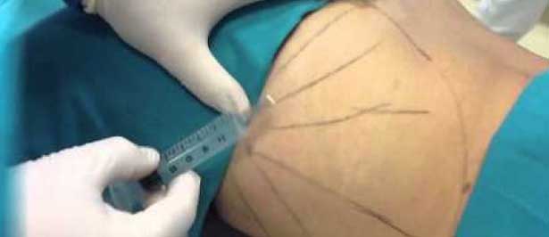 fat zapping injections