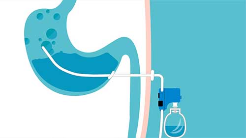 How does AspireAssist Stomach Tube work